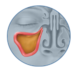 Locate - image of sinus infection