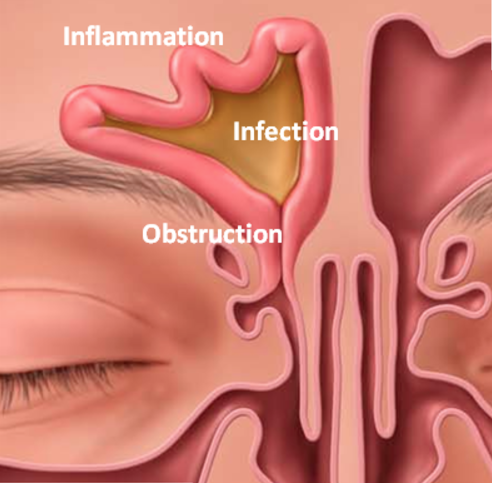 Illustration showing a sinusitis infection